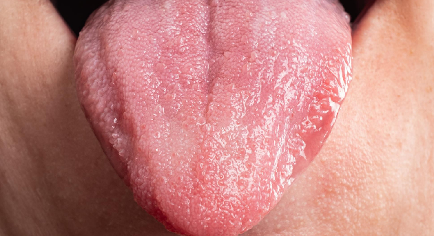 Lesiones por virus de papiloma humano en CDMX y Edo. Mex. en Otorrinolaringología y cirugía de cabeza y cuello